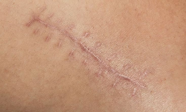 Laceration Treatment in Austin tx